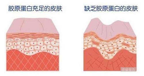 膠原蛋白有沒有用 怎樣補(bǔ)充 你想知道的都在這兒