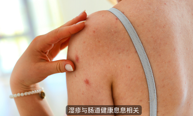 改善濕疹從腸道健康開始 補(bǔ)充益生菌 濕疹少上身