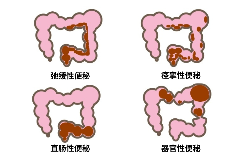 便秘怎么辦？一文看清原因、危害及改善方法