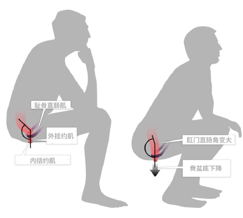 便秘怎么辦？一文看清原因、危害及改善方法