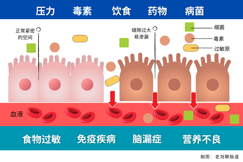 如何判斷自己腸漏癥，癥狀及治療方法